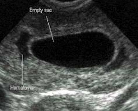 They simply take the report as. . Misdiagnosed miscarriage empty sac